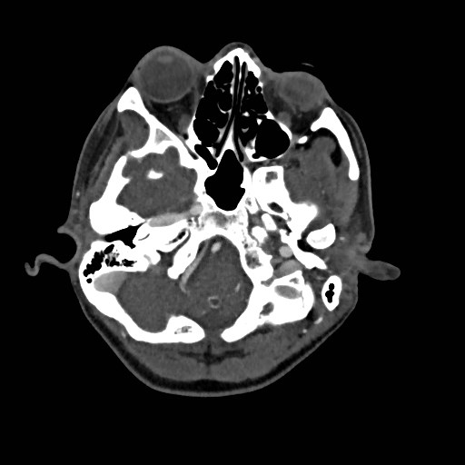 File:Cerebral arteriovenous malformation (Radiopaedia 79677-92888 A 4).jpg