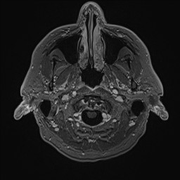 File:Cerebral arteriovenous malformation (Radiopaedia 84015-99245 Axial T1 C+ 17).jpg