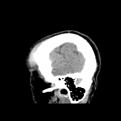 Cerebral arteriovenous malformation (Spetzler-Martin grade 2) (Radiopaedia 41262-44076 A 12).png