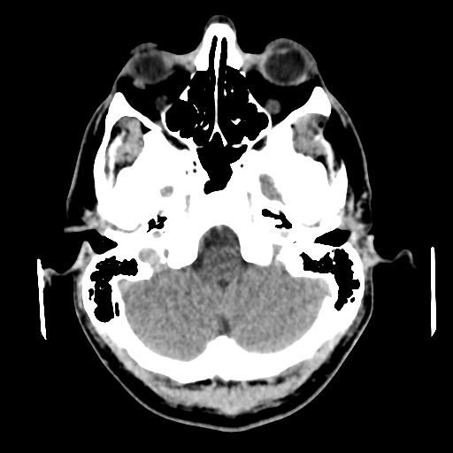 File:Cerebral arteriovenous malformation (Spetzler-Martin grade 2) (Radiopaedia 41262-44076 Axial non-contrast 12).png