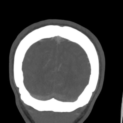 Cerebral arteriovenous malformation (Spetzler-Martin grade 2) (Radiopaedia 41262-44076 F 58).png