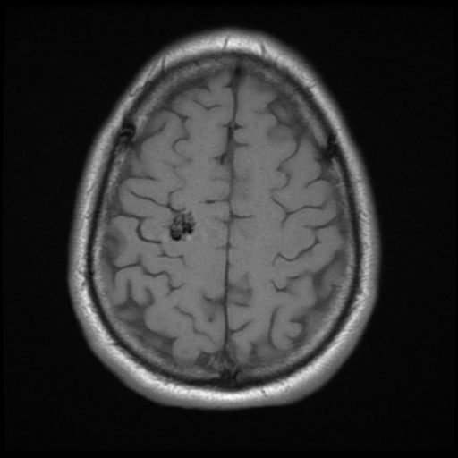 File:Cerebral arteriovenous malformation (Spetzler-Martin grade 2) (Radiopaedia 41262-44092 Axial T1 17).png