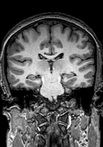 Cerebral arteriovenous malformation at posterior body of corpus callosum (Radiopaedia 74111-84925 Coronal T1 193).jpg