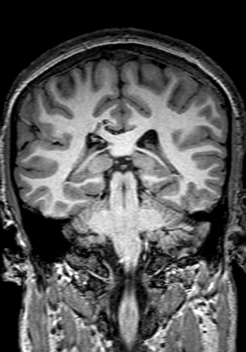 Cerebral arteriovenous malformation at posterior body of corpus callosum (Radiopaedia 74111-84925 Coronal T1 212).jpg