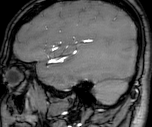 File:Cerebral arteriovenous malformation at posterior body of corpus callosum (Radiopaedia 74111-84925 J 72).jpg