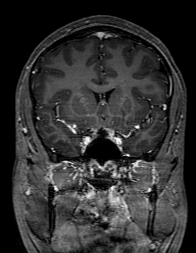Cerebral arteriovenous malformation at posterior body of corpus callosum (Radiopaedia 74111-84925 K 131).jpg