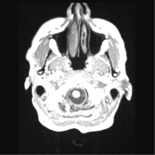 File:Cerebral arteriovenous malformation with hemorrhage (Radiopaedia 34422-35737 Axial T1 6).png