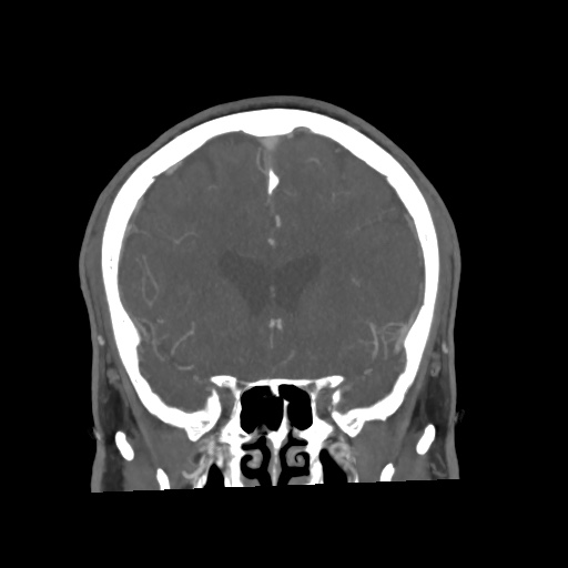 Cerebral arteriovenous malformation with lobar hemorrhage (Radiopaedia 35598-57216 C 33).jpg