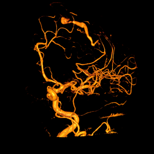 Cerebral arteriovenous malformation with lobar hemorrhage (Radiopaedia 44725-48513 C 25).png