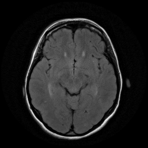 File:Cerebral autosomal dominant arteriopathy with subcortical infarcts and leukoencephalopathy (CADASIL) (Radiopaedia 41018-43768 AX FLAIR (Propeller) 9).png
