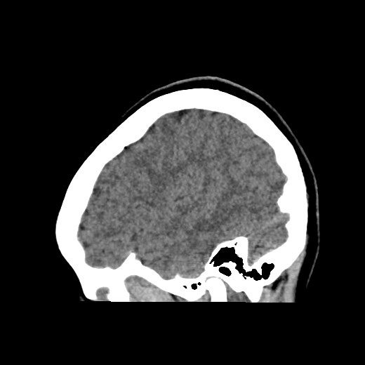 Cerebral cavernous venous malformation (Radiopaedia 70008-80022 C 11).jpg