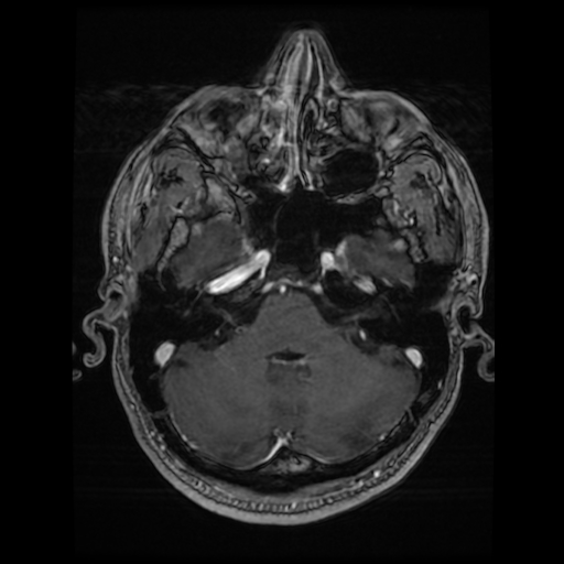 Cerebral cavernous venous malformation (Zabramski type II) (Radiopaedia 85511-101198 Axial T1 C+ fat sat 64).jpg