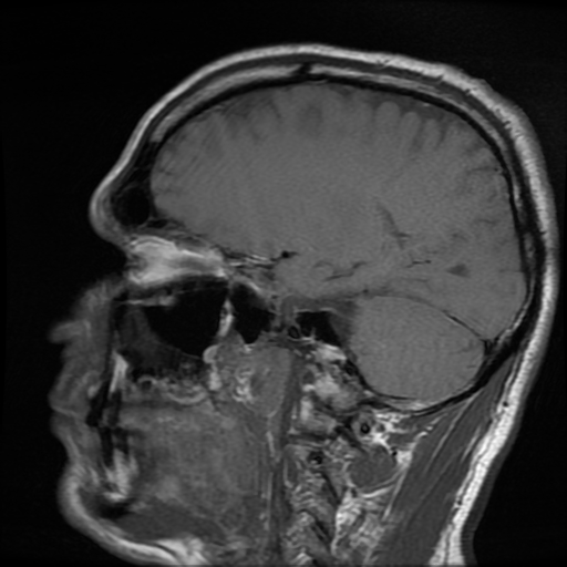 File:Cerebral cavernous venous malformation (Zabramski type II) (Radiopaedia 85511-101198 Sagittal T1 23).jpg