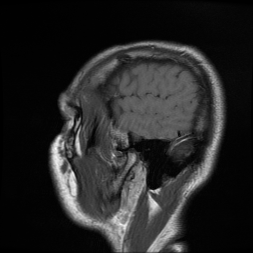 File:Cerebral cavernous venous malformation (Zabramski type II) (Radiopaedia 85511-101198 Sagittal T1 31).jpg
