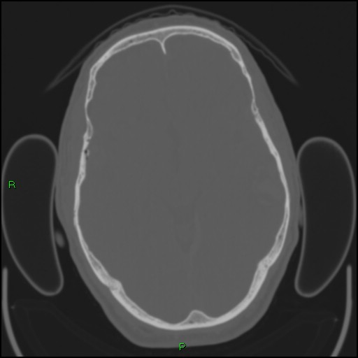 Cerebral contusions (Radiopaedia 33868-35039 Axial bone window 91).jpg