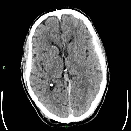 File:Cerebral contusions (Radiopaedia 33868-35039 Axial non-contrast 104).jpg