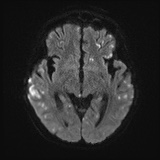 Cerebral embolic infarcts (embolic shower) (Radiopaedia 72391-82921 Axial DWI 43).jpg