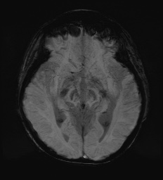 Cerebral embolic infarcts (embolic shower) (Radiopaedia 72391-82921 Axial SWI 32).jpg