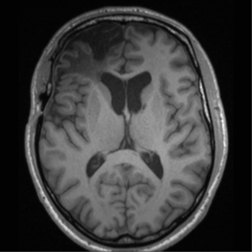 Cerebral hemorrhagic contusions- temporal evolution (Radiopaedia 40224-42757 Axial T1 41).png