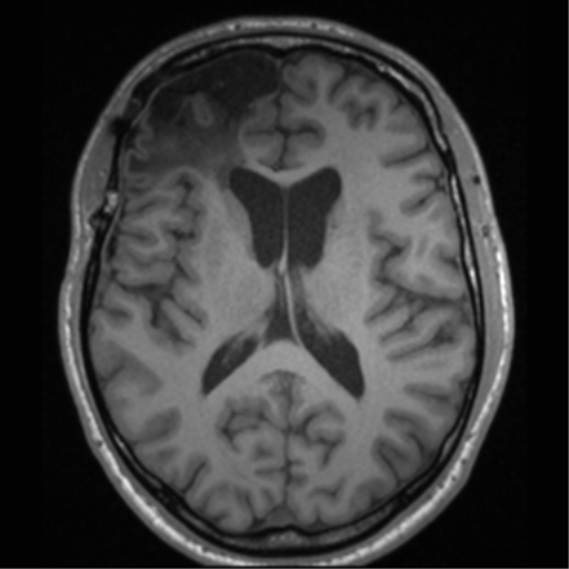 Cerebral hemorrhagic contusions- temporal evolution (Radiopaedia 40224-42757 Axial T1 43).png