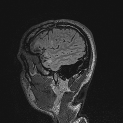 File:Cerebral hemorrhagic contusions- temporal evolution (Radiopaedia 40224-42757 Sagittal T1 68).png