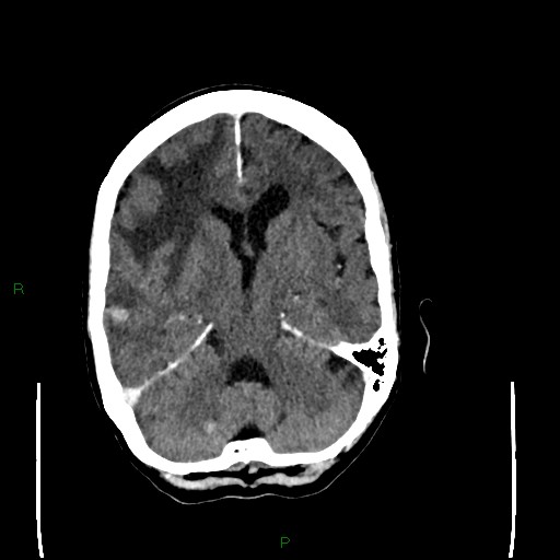 Cerebral metastases - breast primary (Radiopaedia 77653-89857 Axial C+ delayed 50).jpg
