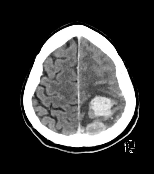 Cerebral metastases - testicular choriocarcinoma (Radiopaedia 84486-99855 Axial C+ delayed 14).jpg