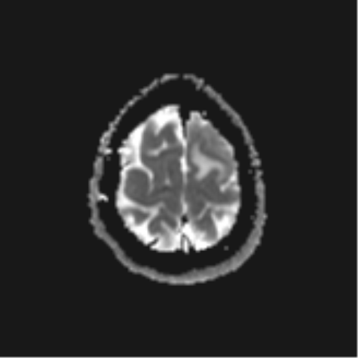 File:Cerebral metastases mimicking abscesses (Radiopaedia 45841-50131 Axial ADC 26).png