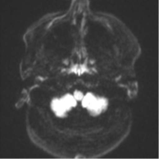 Cerebral metastases mimicking multifocal glioblastoma (Radiopaedia 50843-56353 Axial DWI 31).png