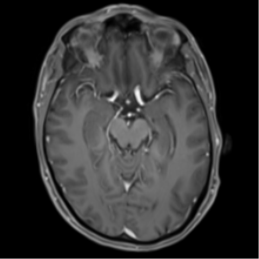 Cerebral metastasis - melanoma (Radiopaedia 54718-60954 Axial T1 C+ fat sat 22).png