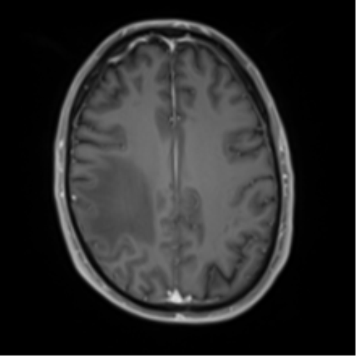 File:Cerebral metastasis - melanoma (Radiopaedia 54718-60954 Axial T1 C+ fat sat 37).png