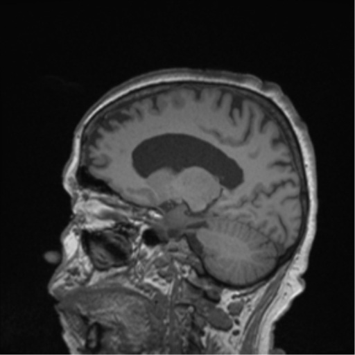 Cerebral metastasis to basal ganglia (Radiopaedia 81568-95413 Sagittal T1 28).png