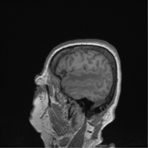 Cerebral metastasis to basal ganglia (Radiopaedia 81568-95413 Sagittal T1 67).png