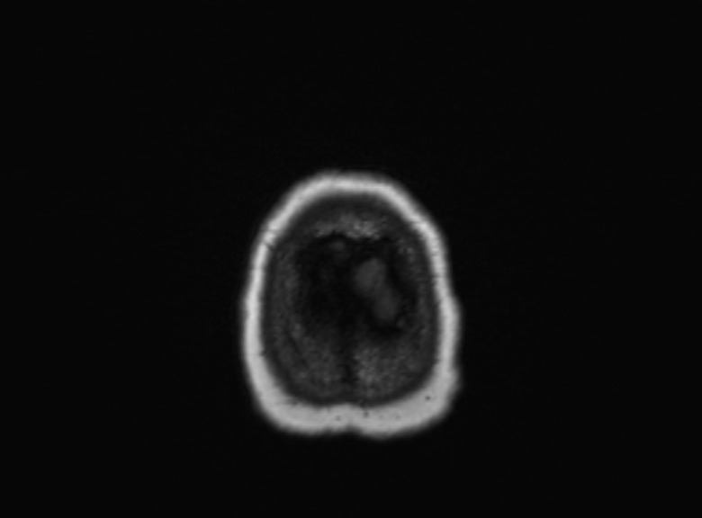 Cerebral ring enhancing lesions - cerebral metastases (Radiopaedia 44922-48817 Axial T1 94).jpg