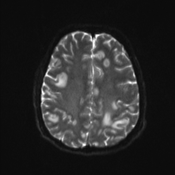 File:Cerebral toxoplasmosis (Radiopaedia 53993-60132 Axial DWI 19).jpg