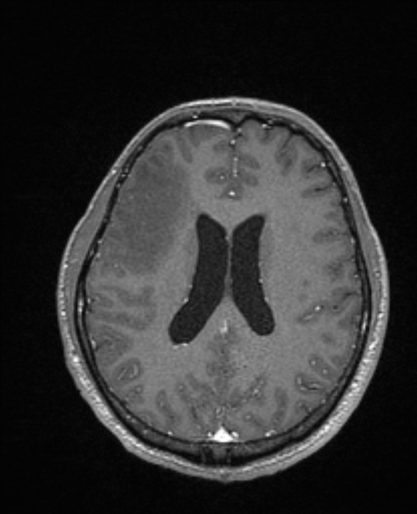 Cerebral toxoplasmosis (Radiopaedia 85779-101597 Axial T1 C+ 102).jpg