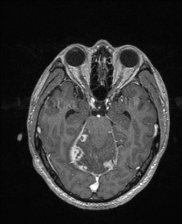 Cerebral toxoplasmosis (Radiopaedia 85779-101597 Axial T1 C+ 60).jpg