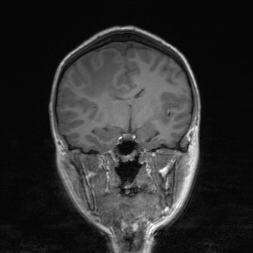 Cerebral tuberculosis with dural sinus invasion (Radiopaedia 60353-68090 Coronal T1 90).jpg