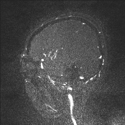 Cerebral tuberculosis with dural sinus invasion (Radiopaedia 60353-68090 Sagittal MRV 26).jpg