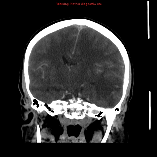 Cerebral venous infarction (Radiopaedia 12404-20735 B 41).jpg
