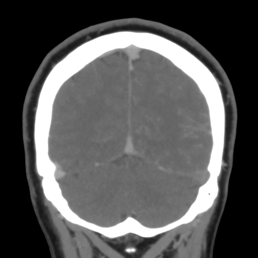 File:Cerebral venous infarction due to transverse sinus thrombosis (Radiopaedia 34688-36120 Coronal 48).png
