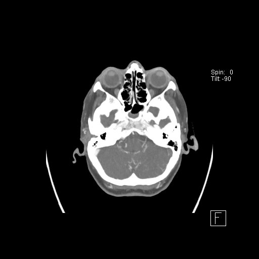 Cerebral venous infarction with hemorrhage (Radiopaedia 65343-74396 A 19).jpg
