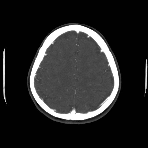 Cerebral venous sinus thrombosis (Radiopaedia 40619-43227 A 183).jpg