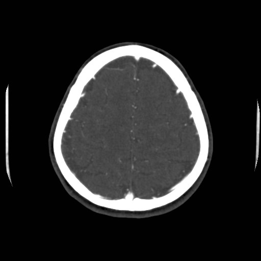 Cerebral venous sinus thrombosis (Radiopaedia 40619-43227 A 185).jpg