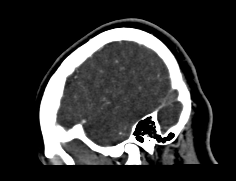 Cerebral venous sinus thrombosis (Radiopaedia 59224-66646 Sagittal C+ delayed 59).jpg
