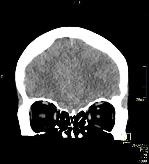 Cerebral venous sinus thrombosis (Radiopaedia 91329-108965 Coronal non-contrast 12).jpg