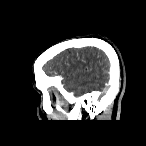 File:Cerebral venous thrombosis (CVT) (Radiopaedia 77524-89685 Sagittal CTV 2).jpg