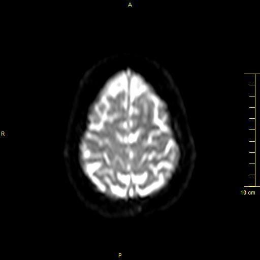 File:Cerebral venous thrombosis (Radiopaedia 23288-23351 Axial DWI 38).JPG