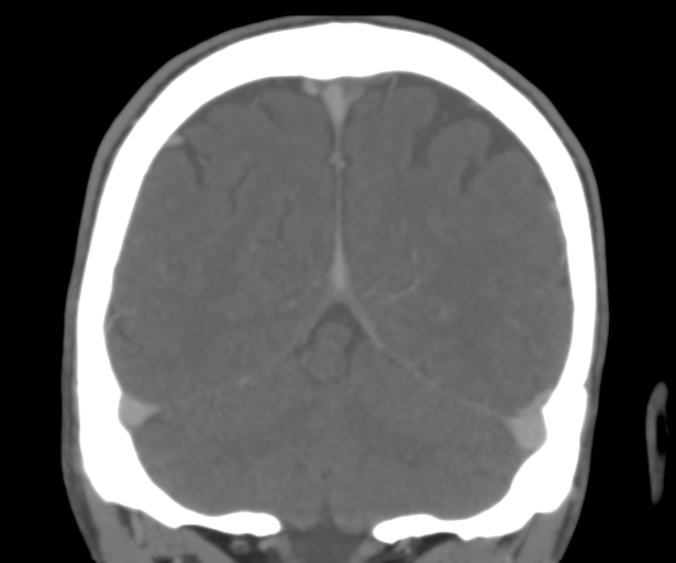 Cerebral venous thrombosis (Radiopaedia 38392-40467 Coronal CTA-Venogram 48).png