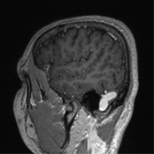 Cerebral venous thrombosis (Radiopaedia 38392-40469 Sagittal T1 C+ 72).png